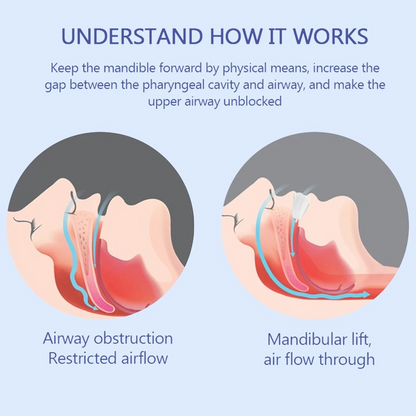 Anti-Snoring Mouthpiece | Helps Stop Snoring | The Original Anti-Snoring Solution | Comfortable & Adjustable